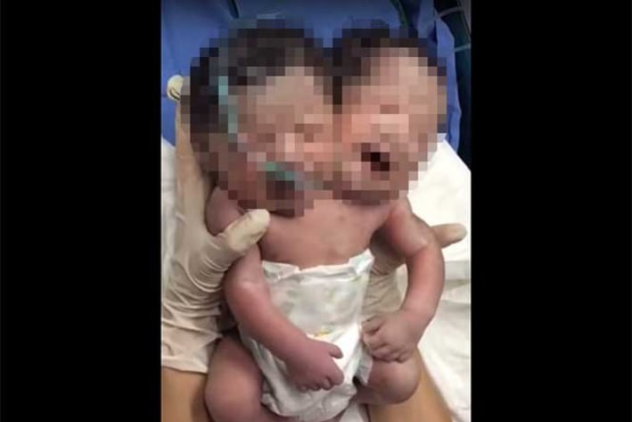 Reportan nacimiento de bebé con dos cabezas