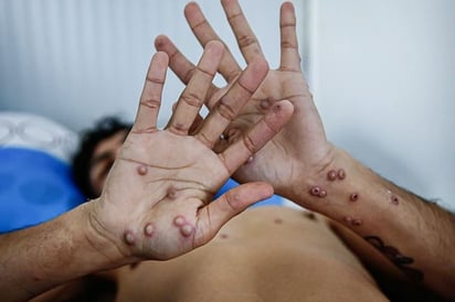 Primer caso de Mpox en Nayarit genera alerta