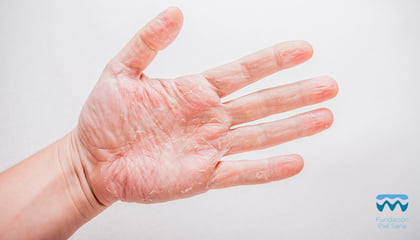 Enfermedades que se pueden prevenir revisando tus manos 