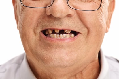 Mala salud dental se relaciona con un mayor riesgo de demencia
