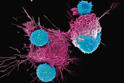 Linfocitos CAR T de donantes se muestran prometedores como tratamiento contra el cáncer