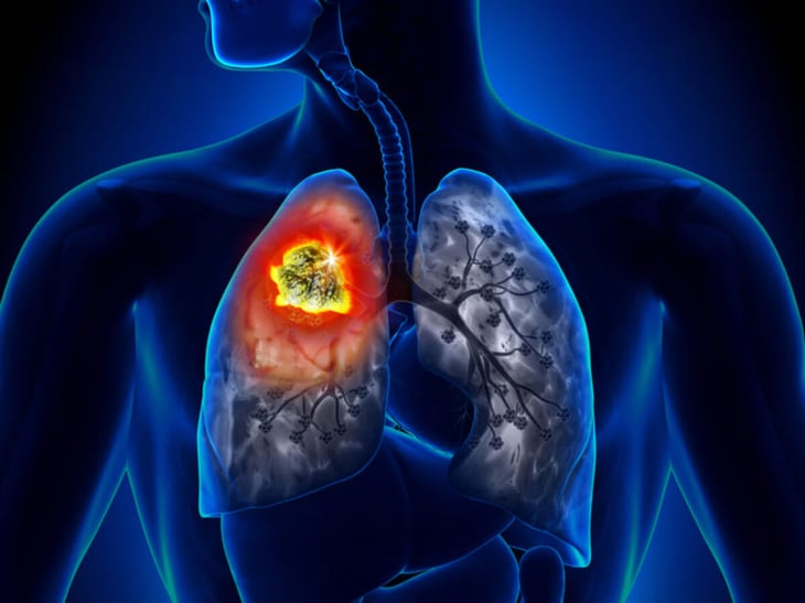 Biomarcadores son herramientas eficaces para tratar mejor el cáncer de pulmón