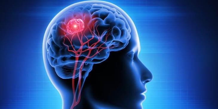 La curación de lesiones cerebrales podría relacionarse con un tipo de cáncer