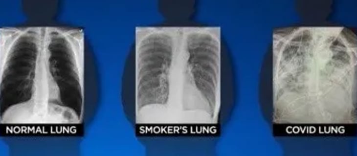COVID-19 daña más a los pulmones que el cigarro: experta