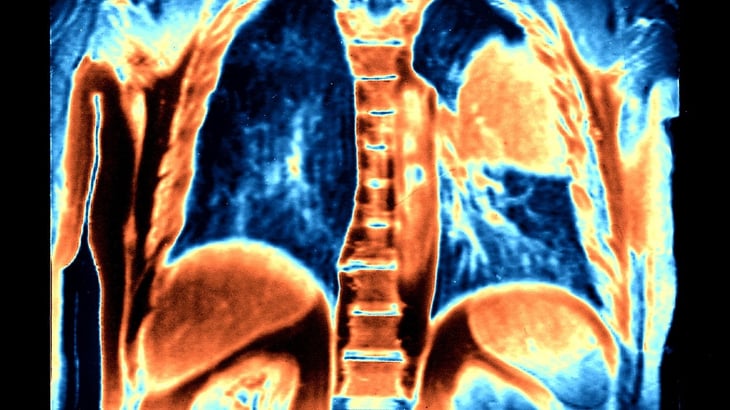 Inmunoterapia es una esperanza de vida para pacientes con cáncer de pulmón