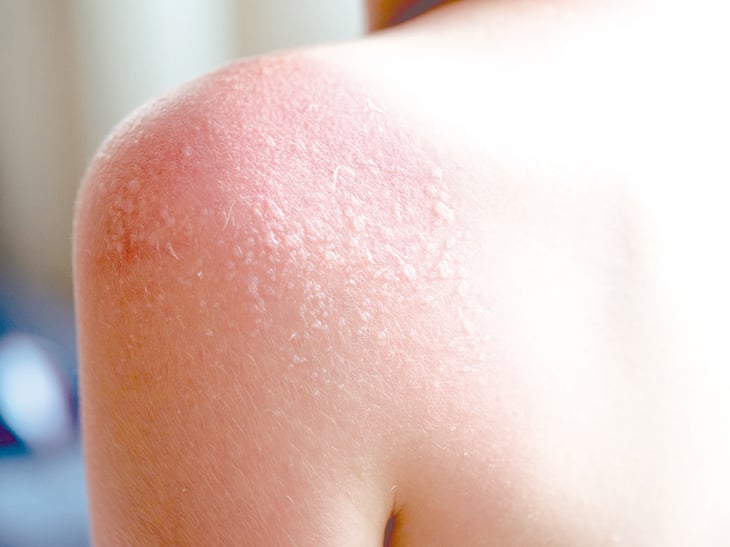 La exposición prolongada al sol ocasiona lesiones en la piel