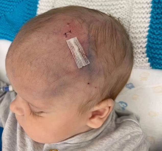 Bebé queda con daño cerebral luego de que médicos del NHS le pusieran un clip de electrodo en la cabeza