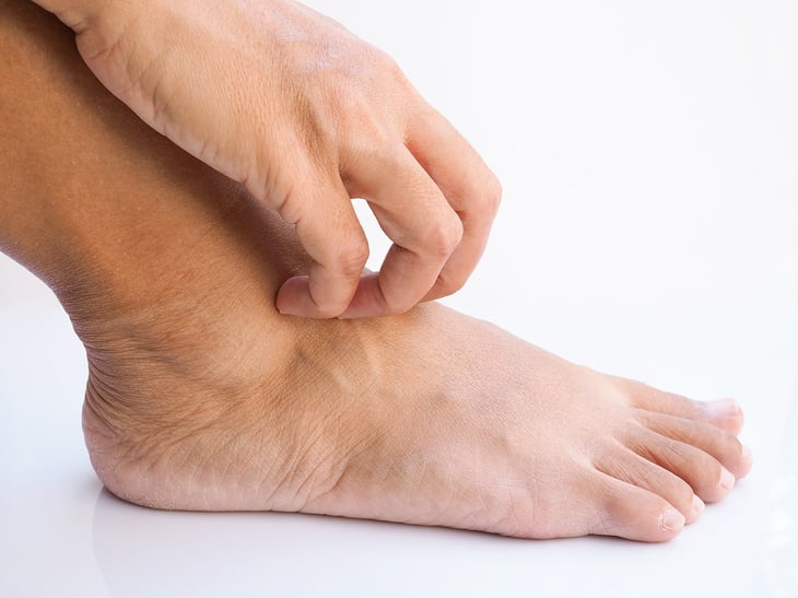 Cómo prevenir la onicomicosis en los pies