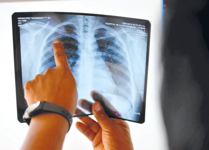 Casos de tuberculosis al alza