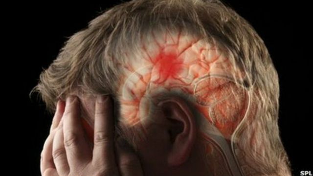 ¿Se puede sobrevivir a un derrame cerebral?