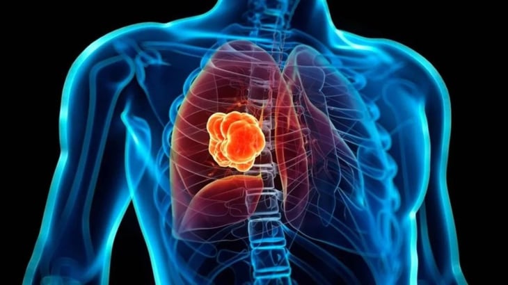 El estigma sigue impidiendo el diagnóstico oportuno de cáncer de pulmón