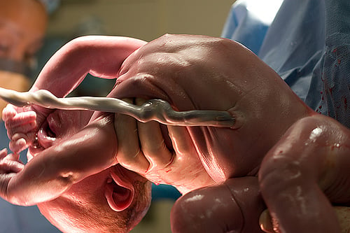 Retrasar el pinzamiento del cordón umbilical salva vidas en los prematuros