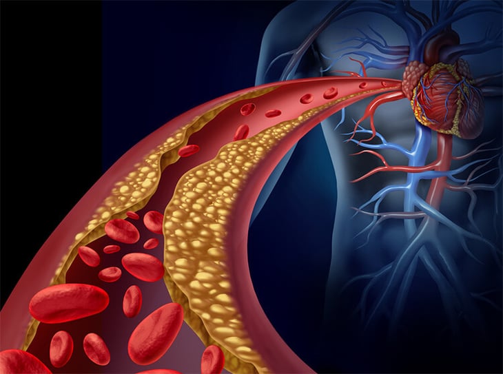 4 signos para saber si tienes colesterol alto