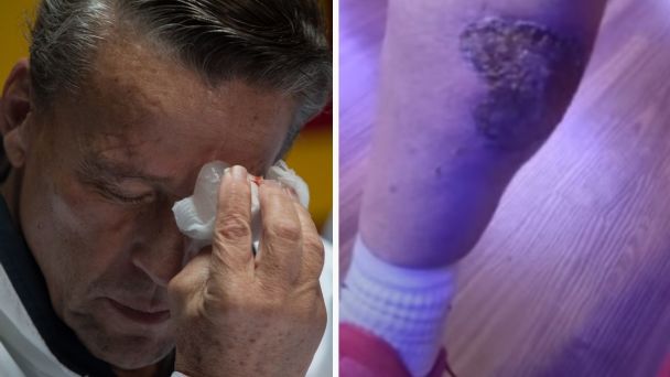 Alfredo Adame sufre grave quemadura en una pierna tras fuerte accidente en moto
