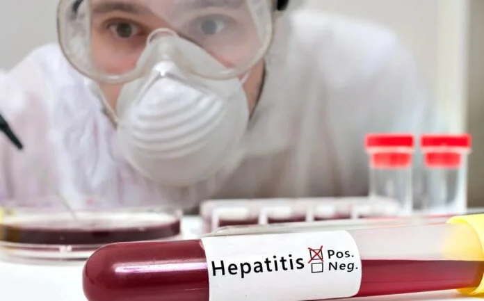 Tres Estados reportan casos sospechosos de hepatitis aguda