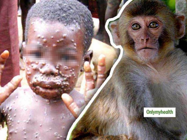 EU detecta primer caso de viruela del mono y España 7