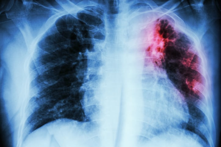 Un paciente con tuberculosis no controlada puede infectar hasta a 10 personas en un año