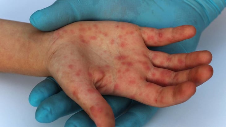 México dice que hasta ahora no ha identificado casos de viruela símica
