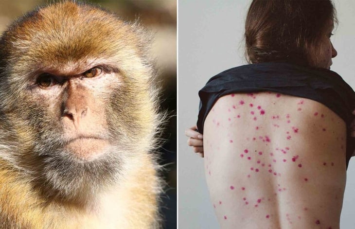 Autoridades sanitarias emiten alerta para detectar casos de viruela del mono 