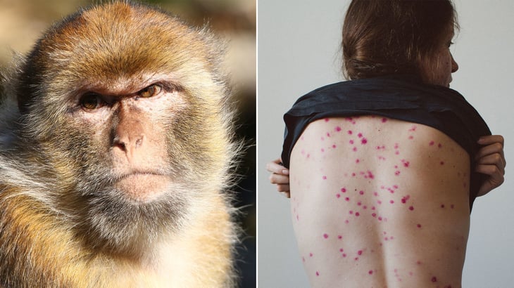 Autoridades de EEUU confirman hasta ahora 12 casos de viruela del mono
