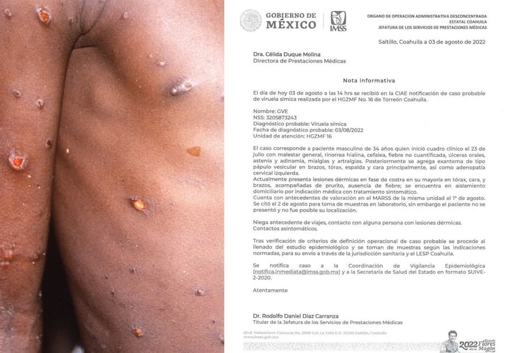 En Torreón hay un caso sospechoso de viruela símica