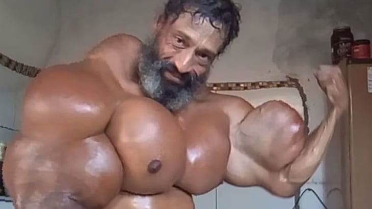 Muere el Hulk brasileño tras inyectarse aceite en sus bíceps por varios años