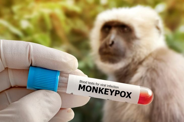 México registra 147 contagios de viruela del mono en 18 estados