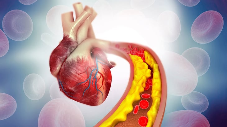 Salud: ¿Qué es el colesterol alto?  te lo explicamos