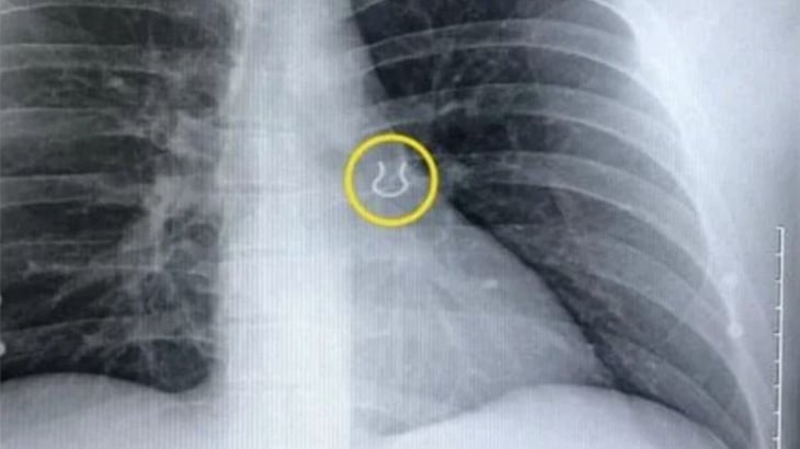 No dejaba de toser, se hizo una radiografía y descubrió piercing en su pulmón