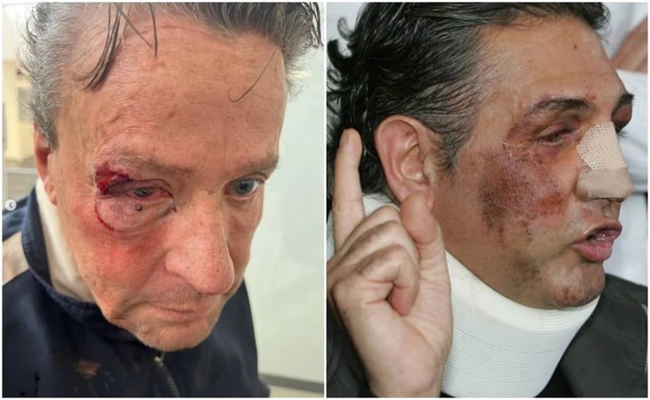 Alfredo Adame muestra su rostro tras cirugía: 'A Fabiruchis le pegaron más'