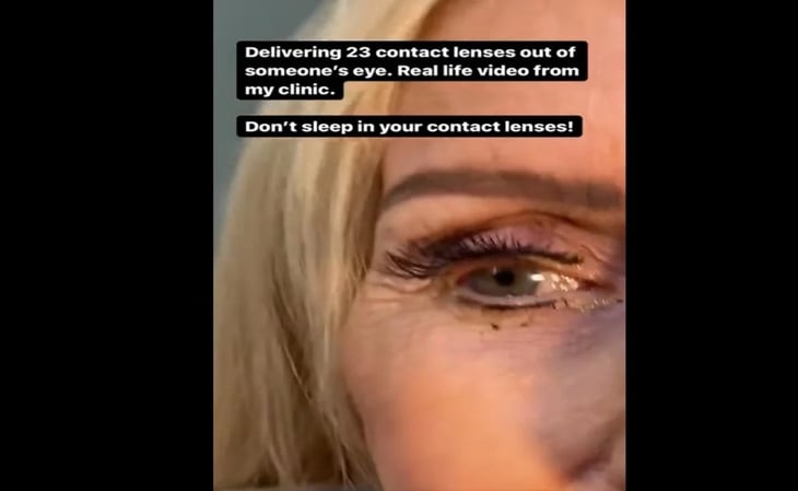 Retiran 23 lentes de contacto de los ojos de una mujer: no sabía que tenía que quitárselos