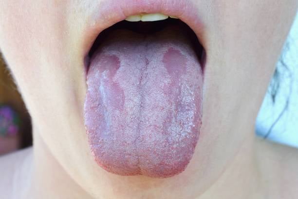 Manchas en la lengua: tratamiento y causas