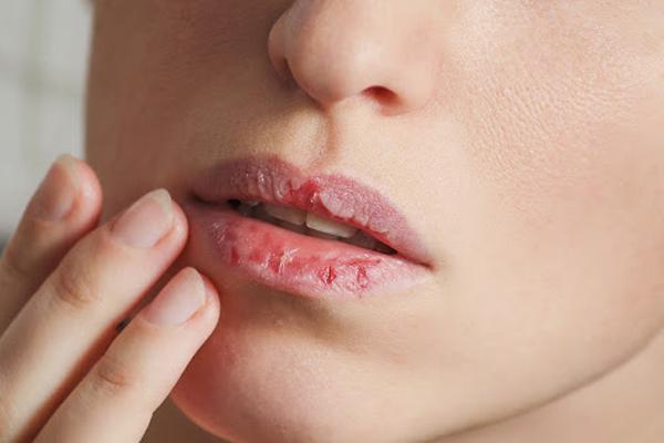 ¿Cómo tratar los labios rotos y resecos en invierno?