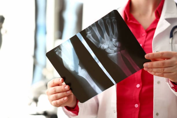 ¿'Tronarse los dedos' realmente provoca artritis?