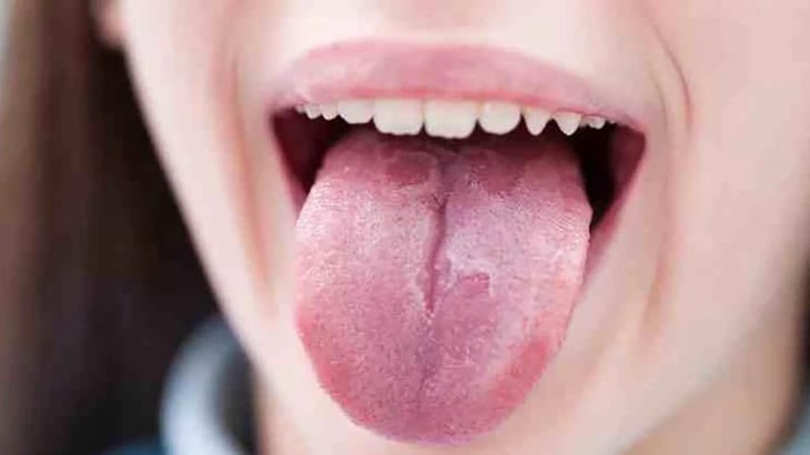 ¿Qué significan las grietas en la lengua?