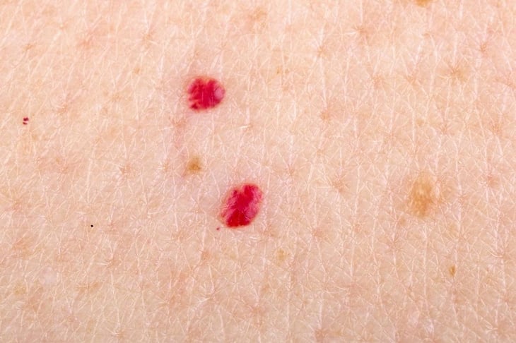 Qué son los puntos rojos en la piel y por qué aparecen