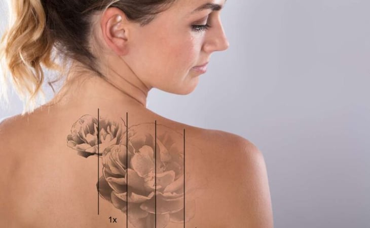 ¿Cuáles son los riesgos de la eliminación de tatuajes con láser?