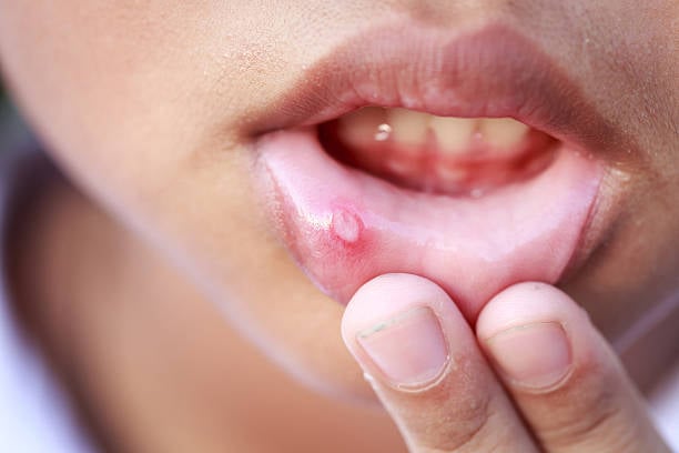 ¿Los alimentos causan llagas en la boca? Aquí te decimos