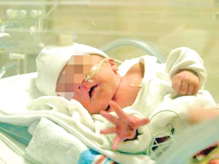 Bebés nacen con parálisis porque madres omiten tomar ácido fólico  
