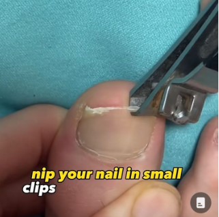 Podólogo comparte la mejor manera de cortar tus uñas
