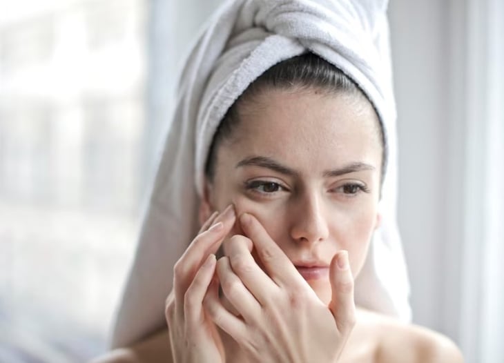 ¿Tienes 'acné adulto? Aprende a tratarlo sin dañar tu piel.