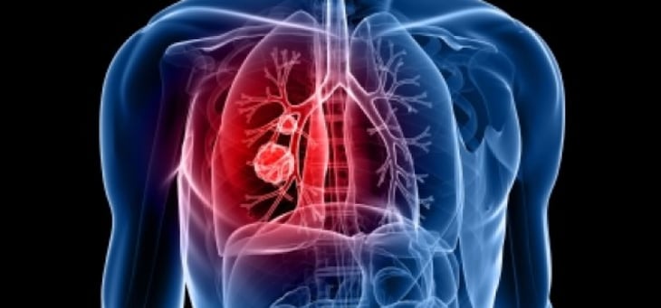 Diabetes podría entorpecer tratamiento para cáncer de pulmón 