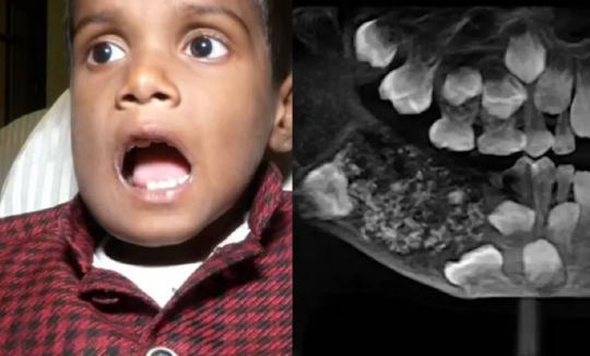 Niño con inusual condición es sometido a cirugía: le extraen 526 dientes