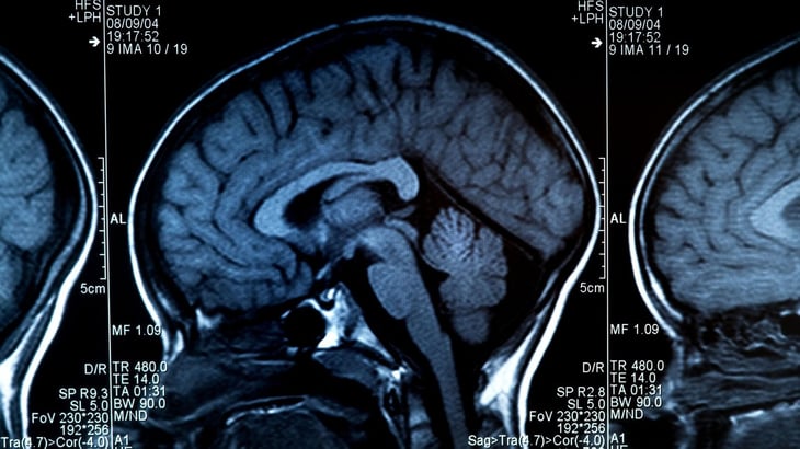 Por qué la mielina podría ser clave para prevenir el Alzheimer y conducir a nuevos tratamientos