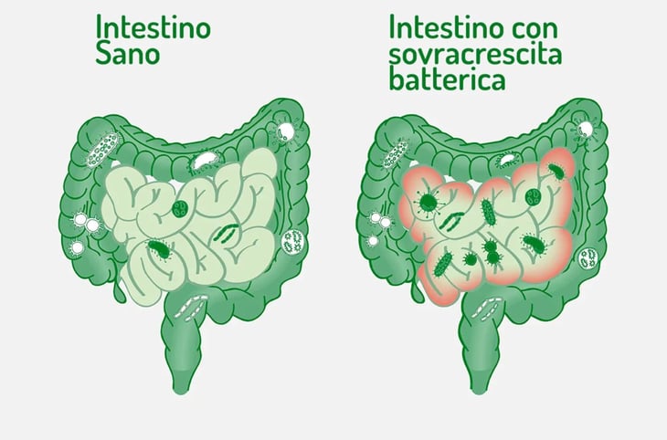 Los males del SIBO, el exceso de bacterias en el intestino delgado que causa diarrea e hinchazón
