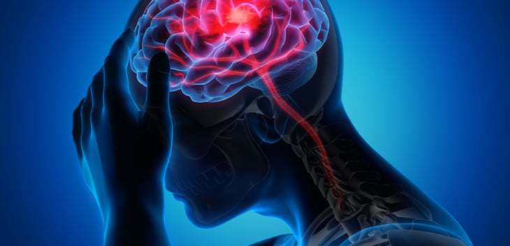 Cuál es la relación entre las arritmias y los accidentes cerebrovasculares