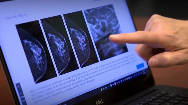 Las mamografías asistidas por IA aumentan la detección del cáncer de mama