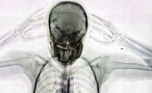 Así se ve en rayos X el cuerpo de una mujer que traficaba 78 cápsulas de cocaína