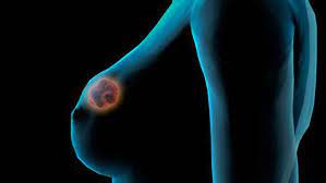 Estimación del sobrediagnóstico de cáncer de mama