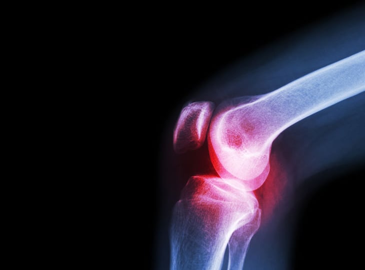 Herramientas para predecir artritis inflamatoria en pacientes en riesgo